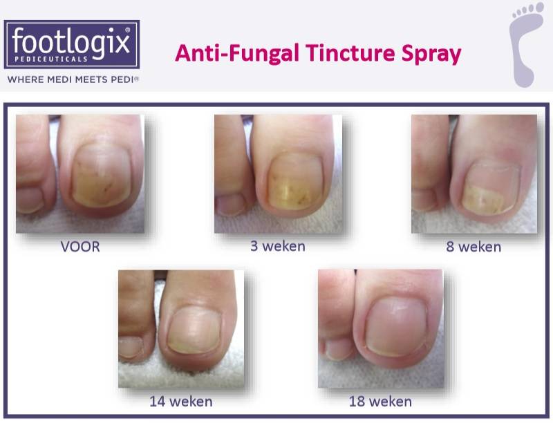 Footlogix Toe Nail Tincture Anti-Schimmel Teennagel Tinctuur Spray nr. 7T