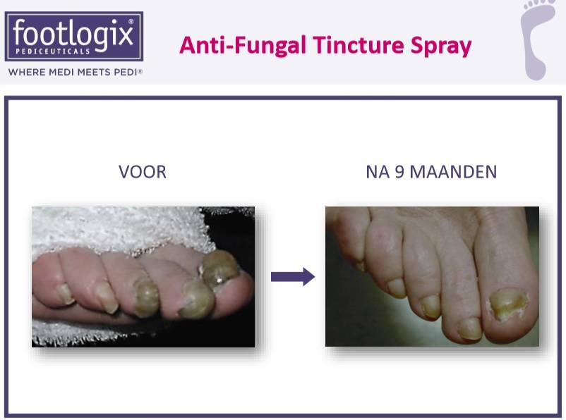 Footlogix Toe Nail Tincture Anti-Schimmel Teennagel Tinctuur Spray nr. 7T