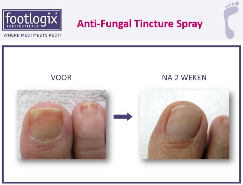 Footlogix Toe Nail Tincture Anti-Schimmel Teennagel Tinctuur Spray nr. 7T