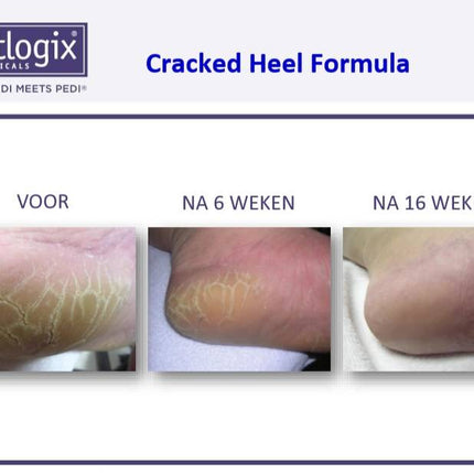 Footlogix Cracked Heel Formula tegen Ernstige Kloven 3+