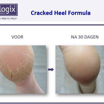 Footlogix Cracked Heel Formula tegen Ernstige Kloven 3+