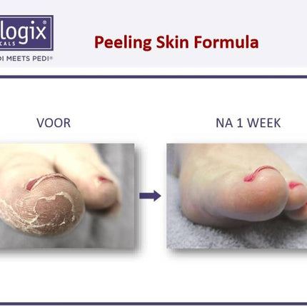 Footlogix Peeling Skin Formula tegen Loskomend Huid nr.7