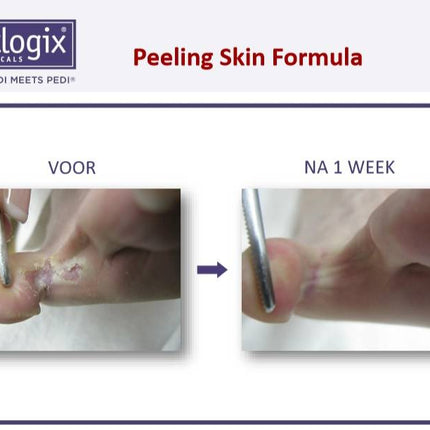 Footlogix Peeling Skin Formula tegen Loskomend Huid nr.7