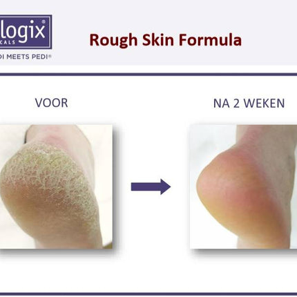 Footlogix Rough Skin Formula tegen Droge, Ruwe Huid 7+